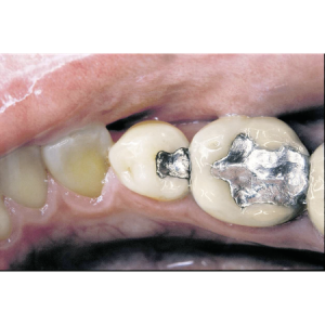 Amalgam Sagadent