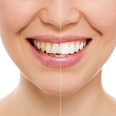 Bleaching Ästhetische Zahnheilkunde Sagadent