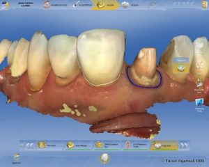 CEREC Omnicam Sagadent