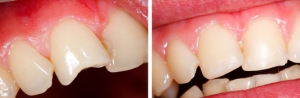 Füllungen Ästhetische Zahnheilkunde Sagadent