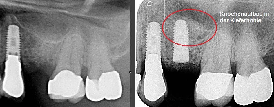 Implantate Röntgenaufnahmen