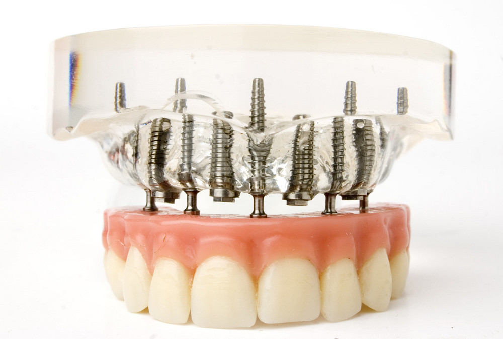 Implantatprothese Zahnersatz Sagadent