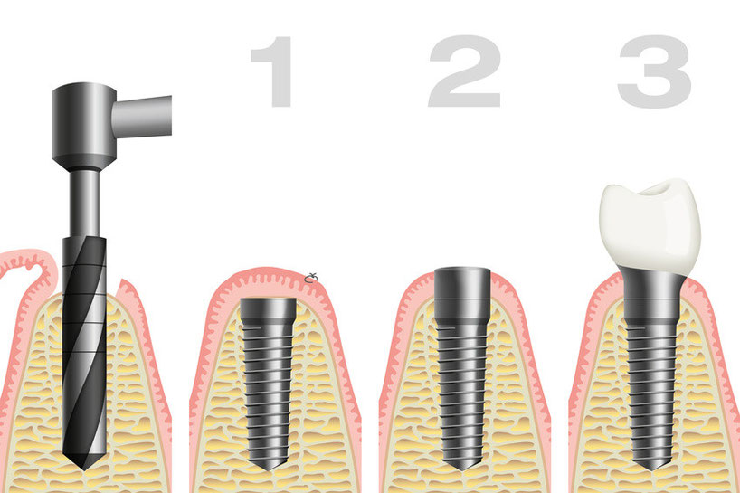 Ablauf Implantologie