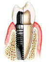 Implantologie Implantologie Sagadent