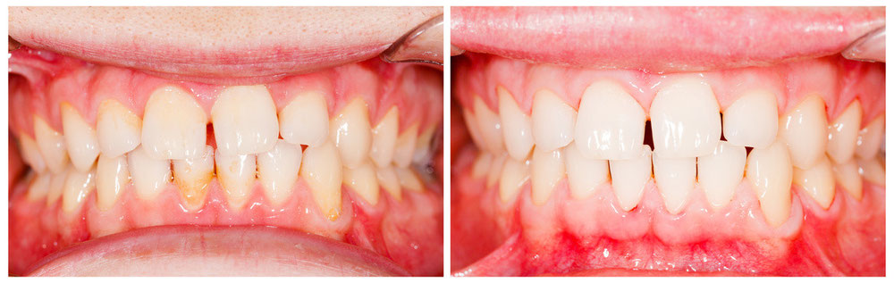 Professionelle Zahnreinigung bei Mundgeruch Sagadent