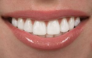 Veneers Ästhetische Zahnheilkunde Sagadent