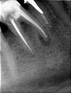 Röntgenaufnahme zur Wurzelkanalbehandlung Sagadent