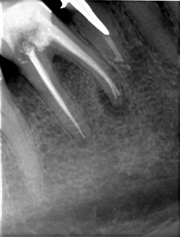 Röntgenaufnahme Zahn Sagadent